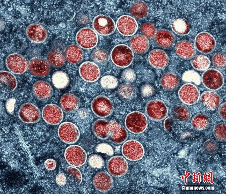 我国发现一起猴痘病毒聚集性疫情
